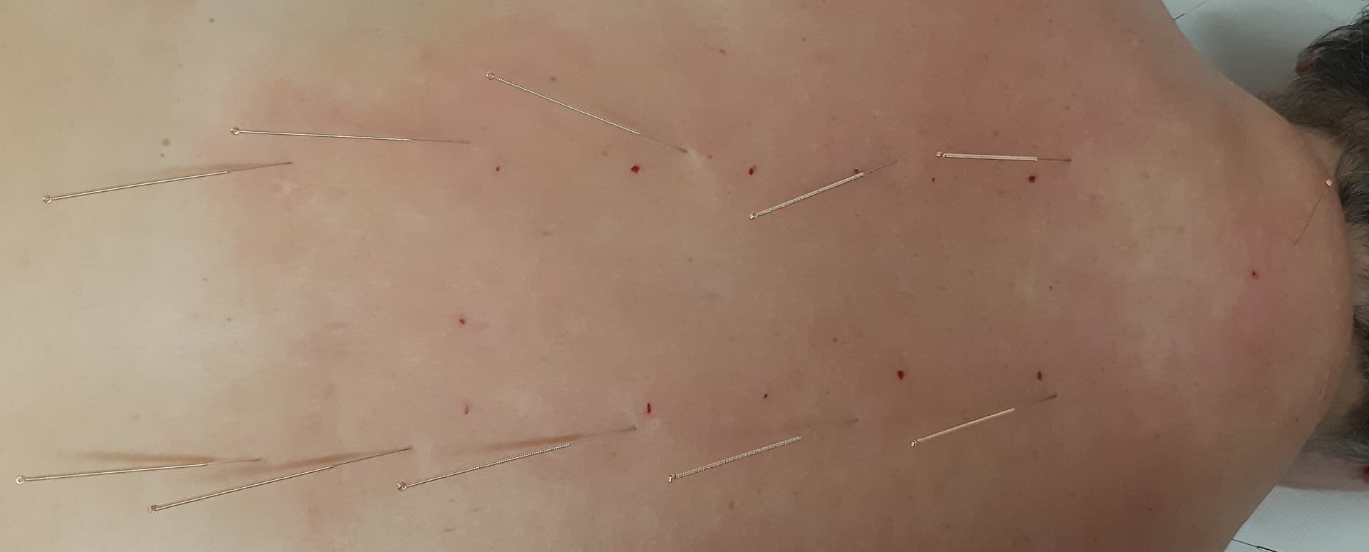 Sessione di agopuntura cervicale